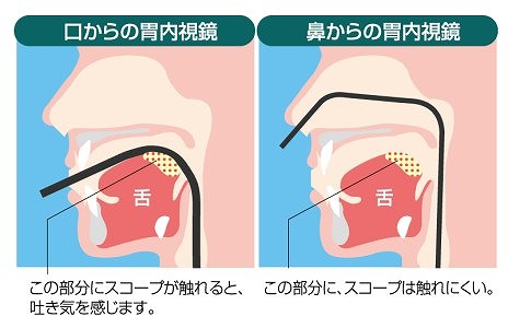 選べる経口と経鼻内視鏡