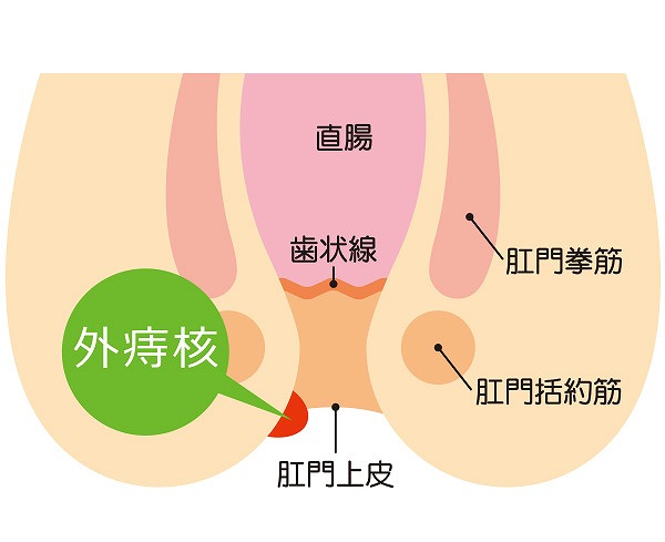 外痔核とは