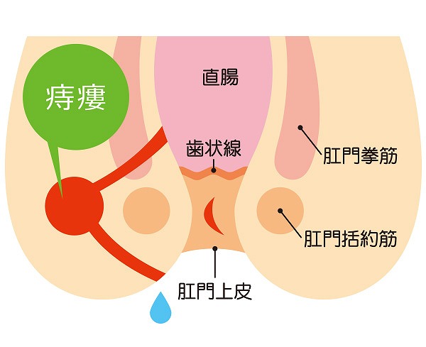 痔ろう（じろう/あな痔）