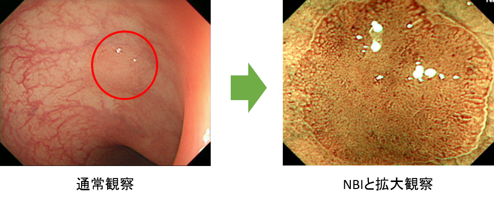 特殊光を使ったNBI